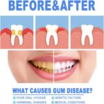 EELHOE Pro - Tandvlees Herstel & Whitening Gel - Afbeelding 8